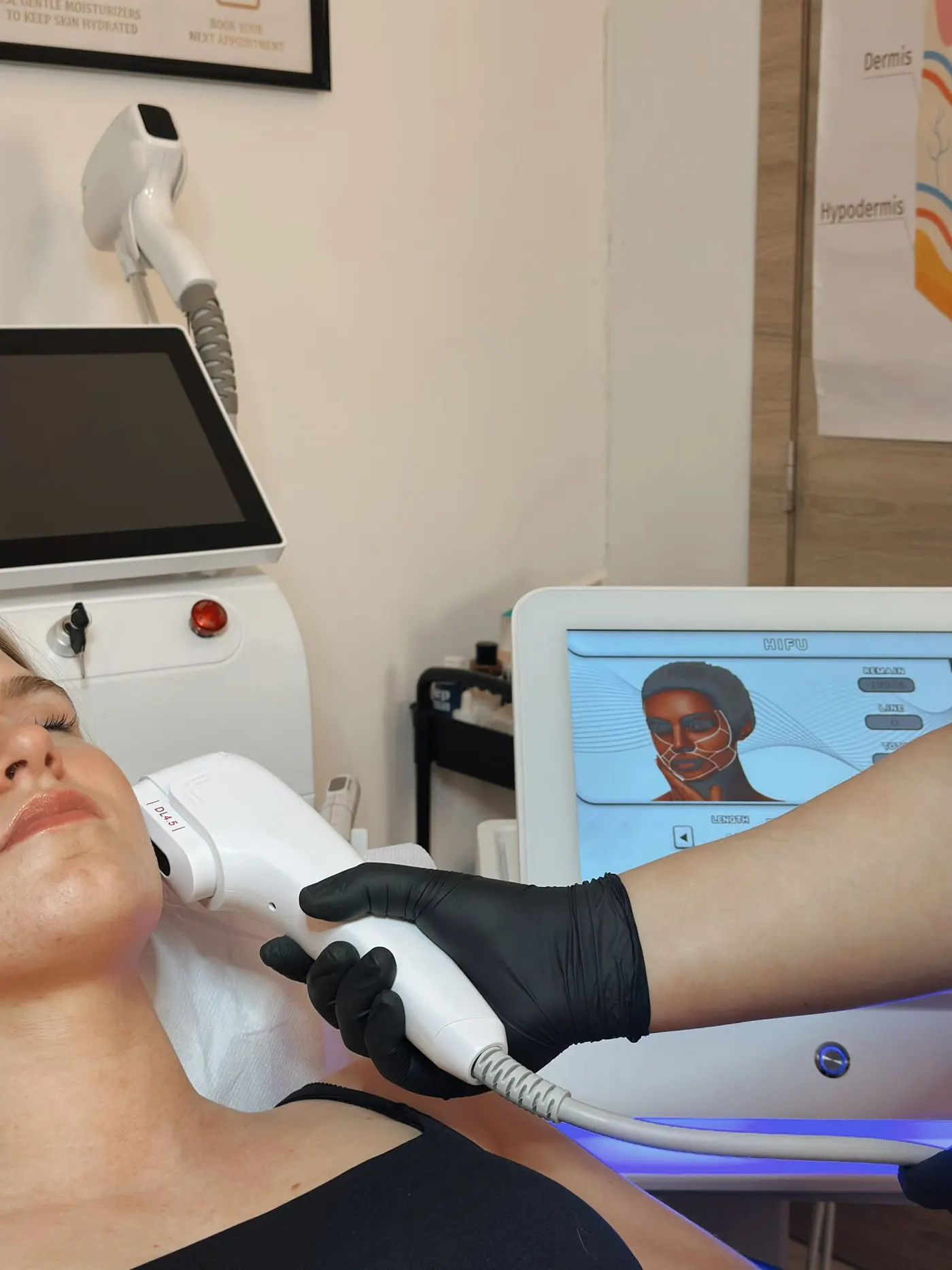 HIFU facelift behandeling Gent