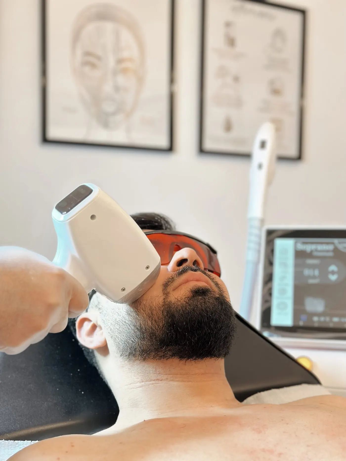 Laser ontharing gezicht Gent