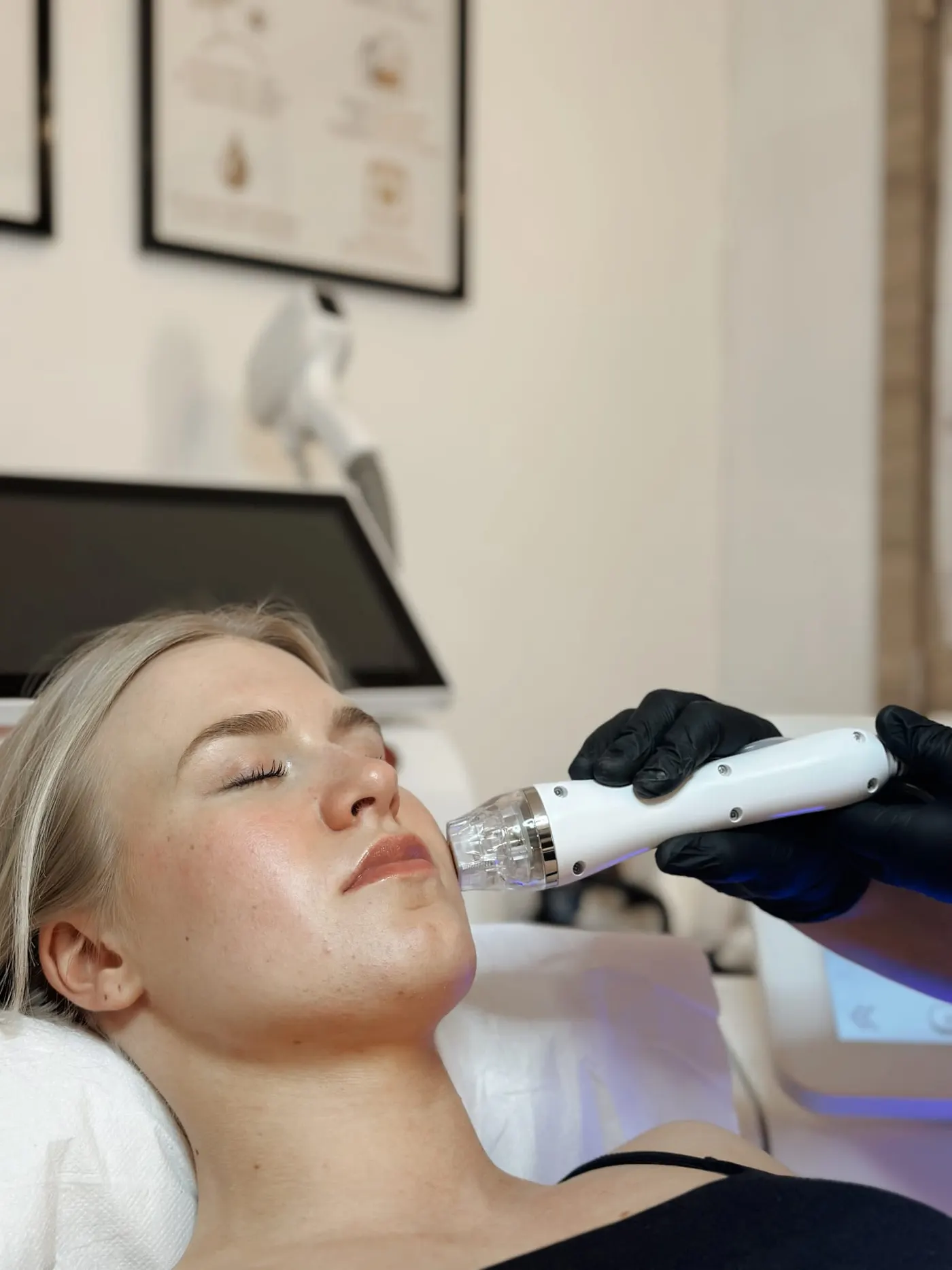 Microneedling huidverbetering Gent